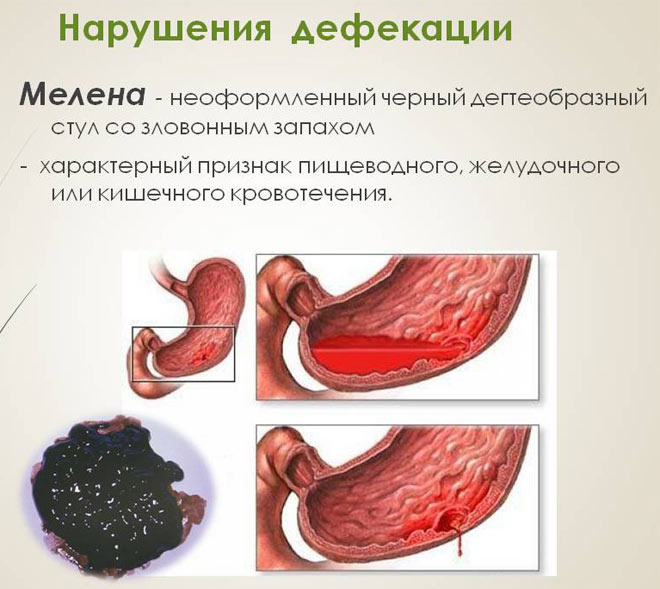 Понос черного цвета у взрослого и ребенка — причины, методы лечения