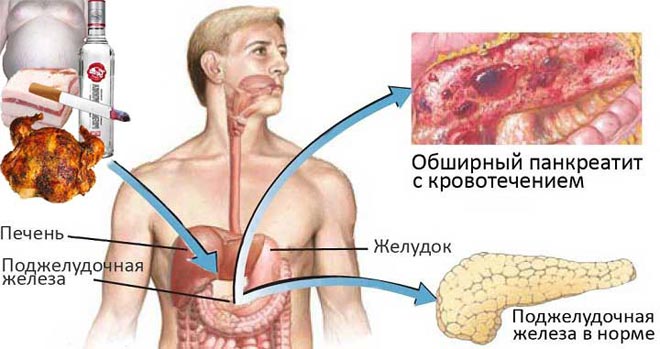 Появление поноса после употребления алкоголя — причины и алгоритм первой помощи