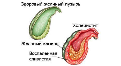 Причины развития и лечение поноса после употребления жирной пищи