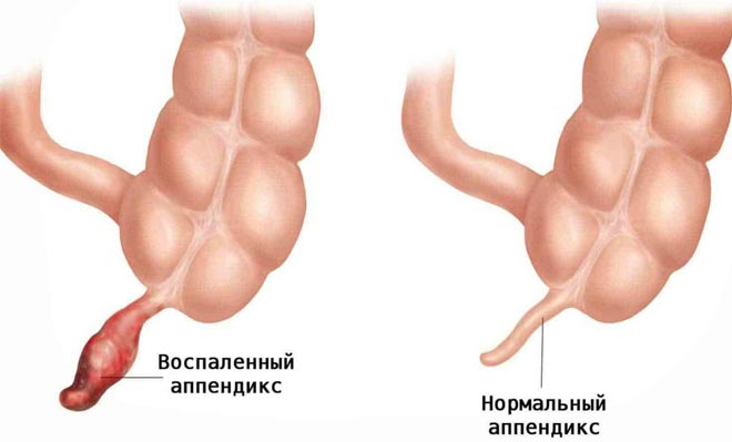 Возможно ли появление поноса при аппендиците как симптома заболевания?