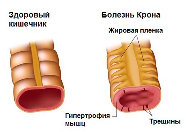 Понос сразу после еды — причины недуга и лечение