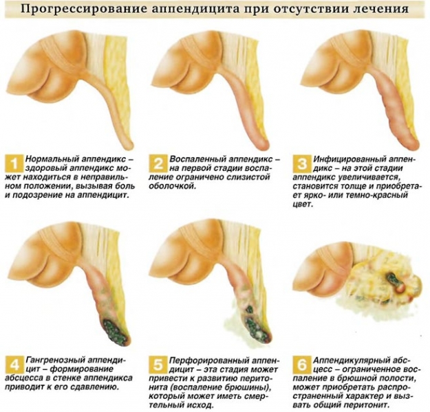 Возможно ли появление поноса при аппендиците как симптома заболевания?