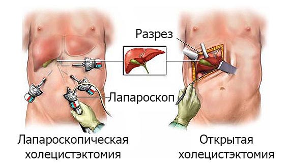 Причины развития хологенной диареи и методы борьбы