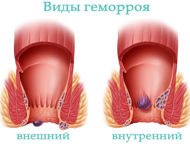 Особенности лечения и риски диареи при геморрое