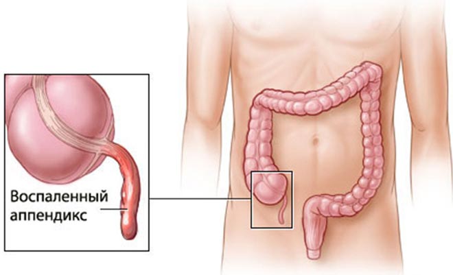 Возможно ли появление поноса при аппендиците как симптома заболевания?