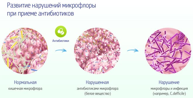 Причины развития поноса белого цвета у ребёнка